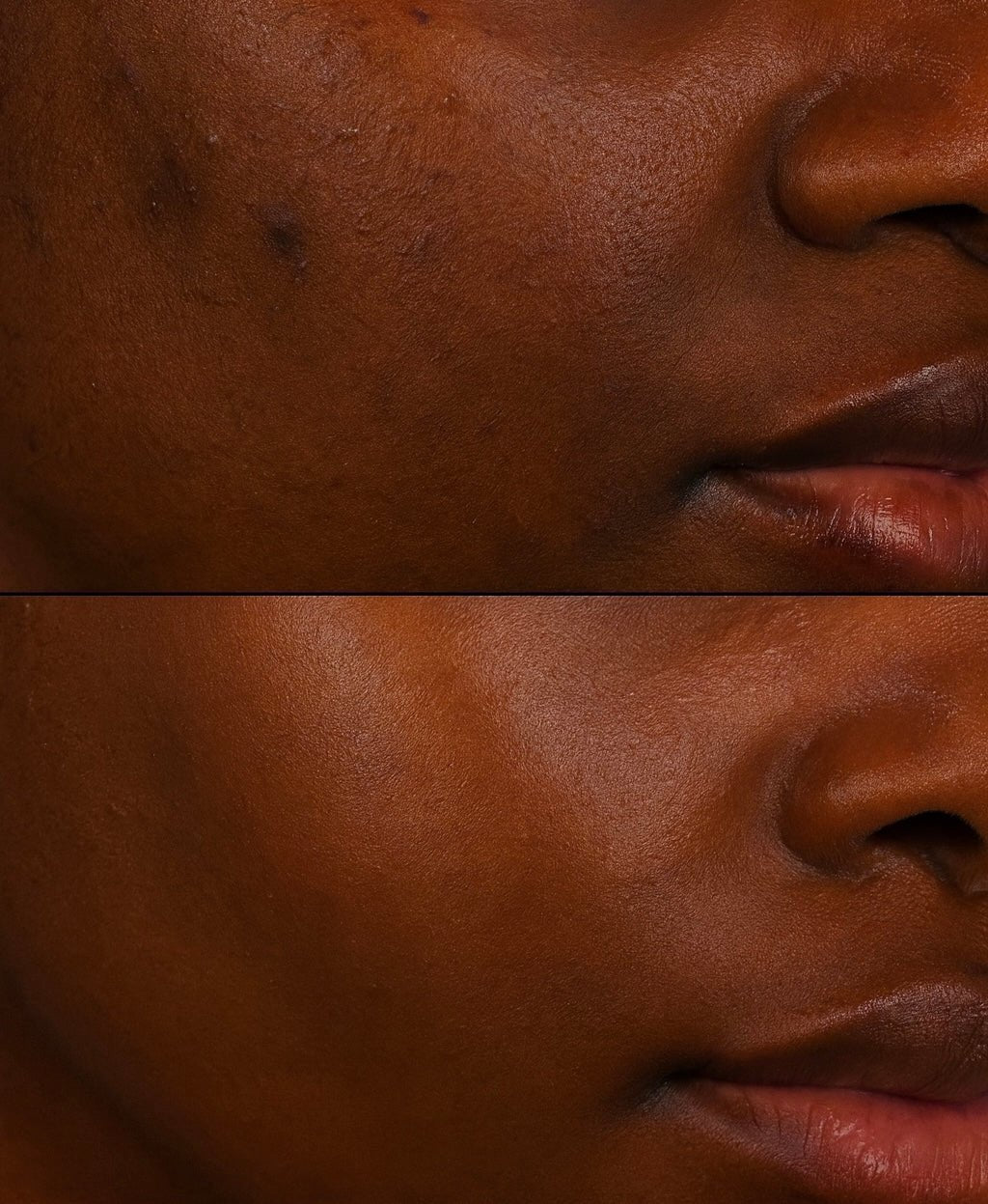 Taches & Hyperpigmentation - B.